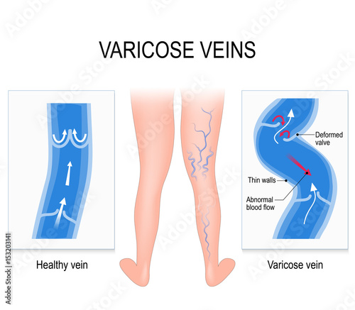 Varicose veins. Medical illustration