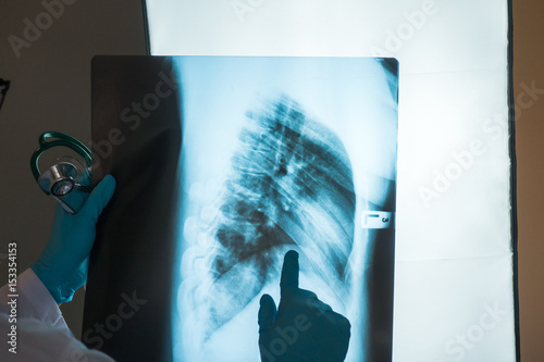 doctor checking chest x-ray film at ward hospital. photo