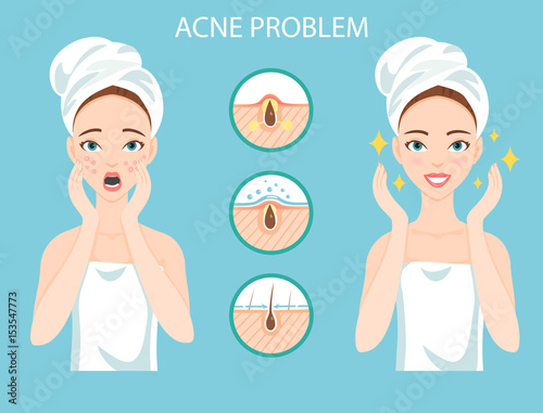 Troubled teen with female facial skin problem needs to care about: infographic of acne disease and stages of it's treatment.