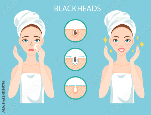 Troubled woman with female facial skin problem needs to care about: infographic of clogged nose pores and blackheads. Stages of treatment and clearing.