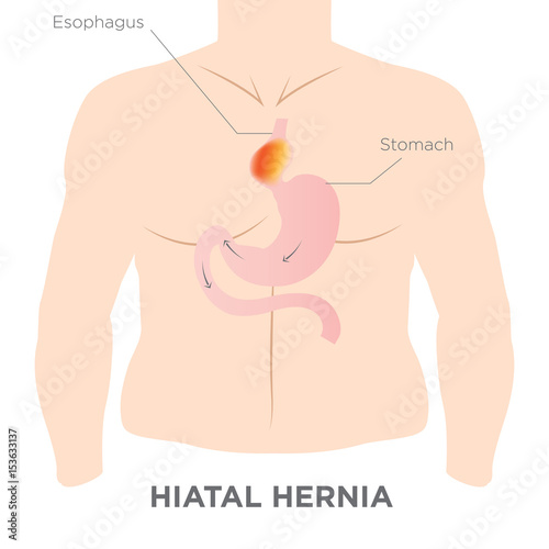 Hiatus Hernia Stomach Image