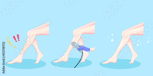 leg hair removal concept