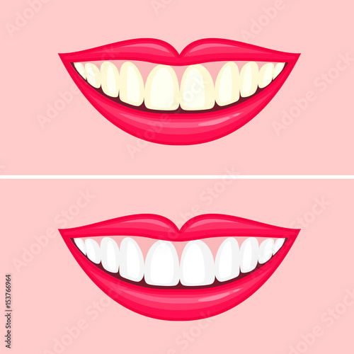 bleaching teeth treatment. Whiten teeth before and after. Vector illustration isolated on pink background. Dental care concept.