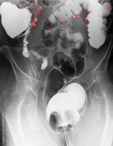 barium contrast X-ray, diverticulosis in the colon photo