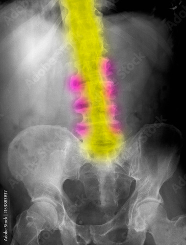 X-ray, osteoarthritis of the spine, bone spurs photo