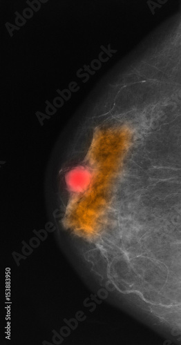 Mammogram with colloid carcinoma.