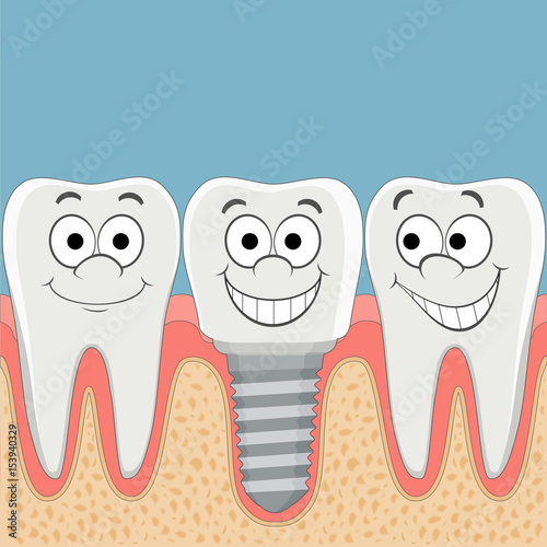 Human teeth and dental implant.