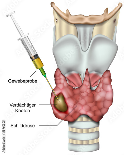 Feinnadelbiopsie der Schilddrüse
