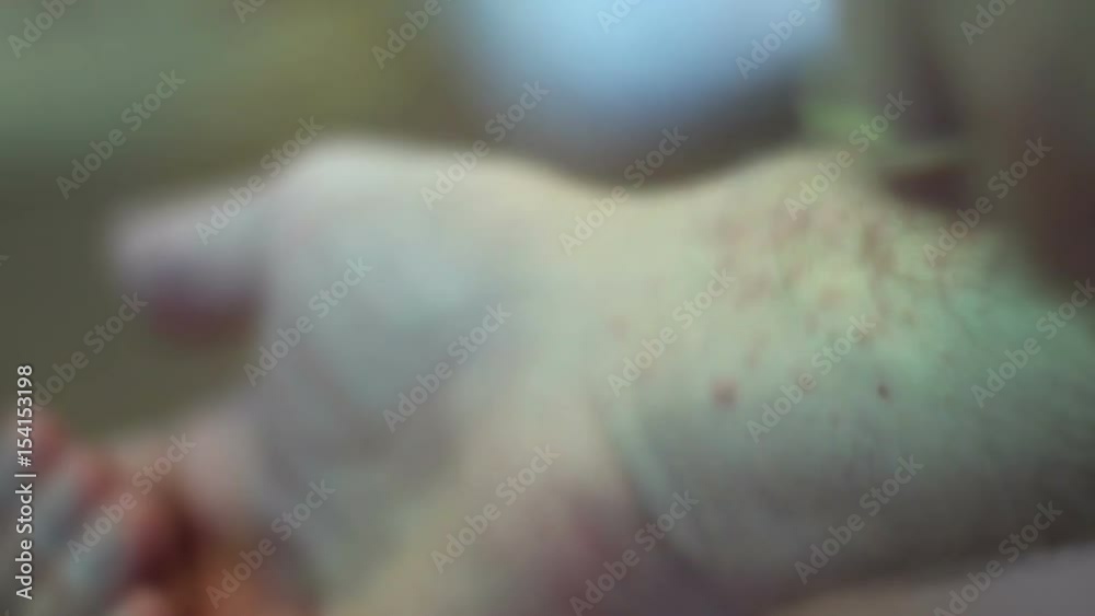 Man itching poison ivy or sumak bumpy infection along is forearm