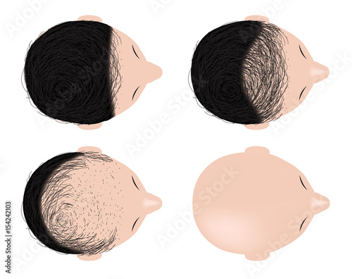 type of baldness , bald head vector . no hair