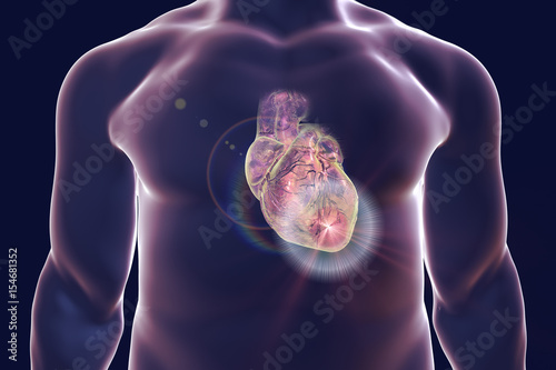 Heart attack, conceptual image for heart diseases. 3D illustration