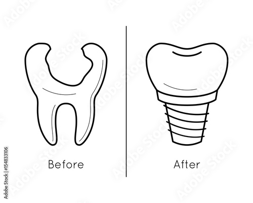 Icons of tooth and dental implant in thin line style. Dentist, orthodontics technology - reconstruction and prosthetic teeth. Dental problem. Vector outline simple illustrations isolated on white