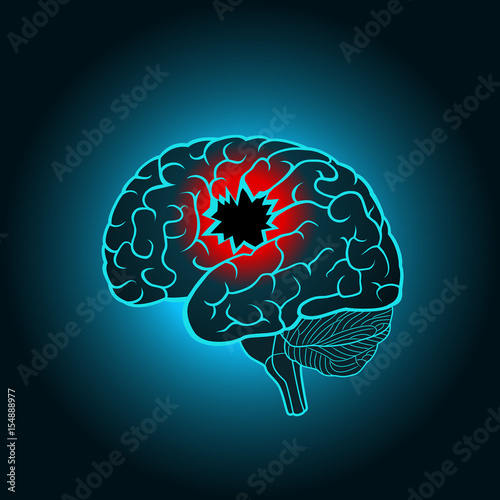 A brain with a hole, the concept of destruction of the brain, memory, stroke, injury