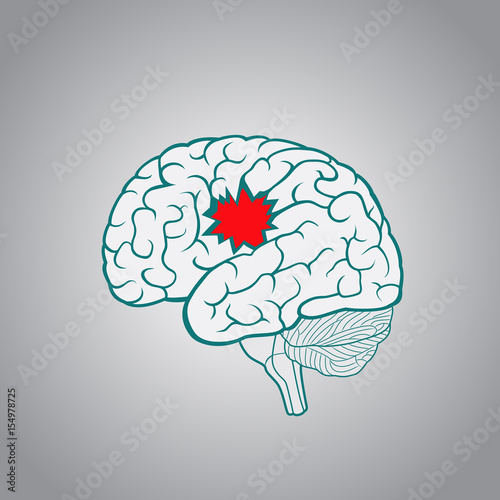 A brain with a hole, the concept of destruction of the brain, memory, stroke