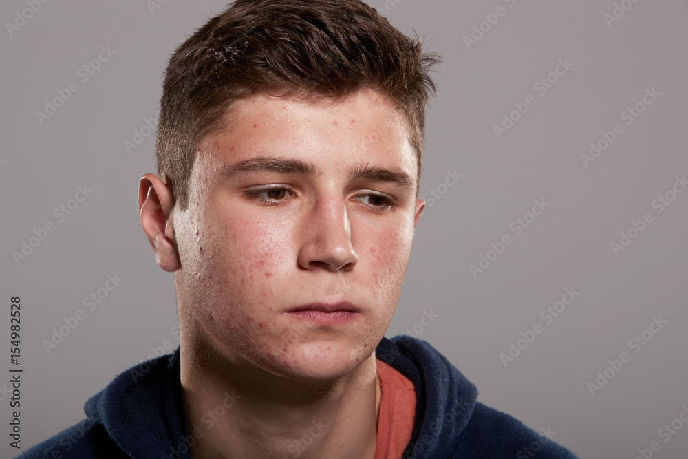 Teenage boy with acne looking down, head and shoulders portrait Teenage boy with acne looking down, head and shoulders portrait