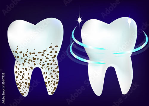 Vector set of 3d realistic clean and dirty tooth on blue background, clearing tooth process. Teeth Whitening. Dental health Concept. Oral Care, teeth restoration