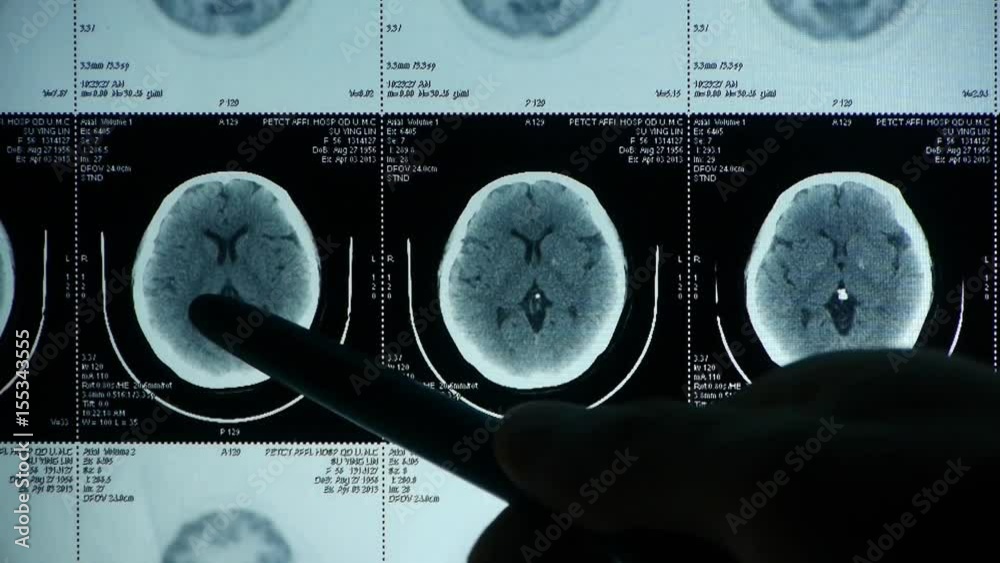 doctor study head pet/ct scan for analysis the disease,skull brain X ...