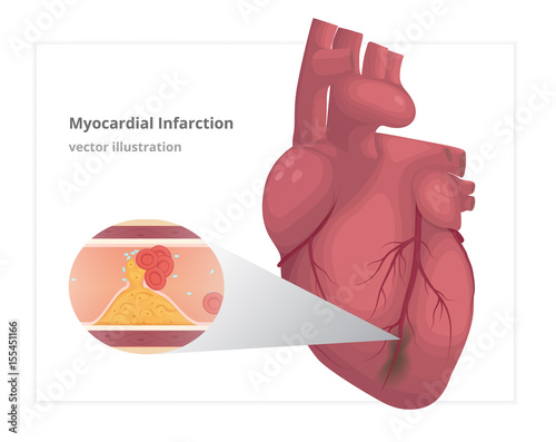  Myocardial infarction vector illustration. Cardiac infarct