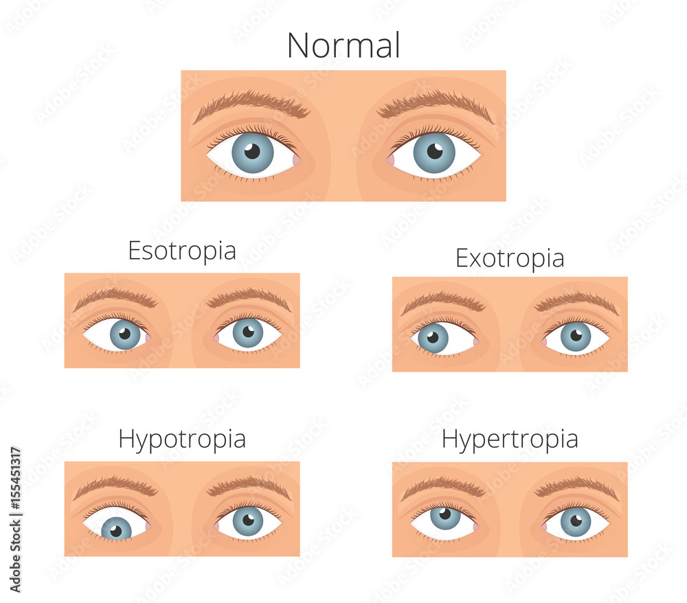 Vecteur Stock Crossed eyes vector illusration. Types of crossed eyes |  Adobe Stock