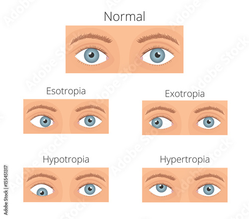 Crossed eyes vector illusration. Types of crossed eyes