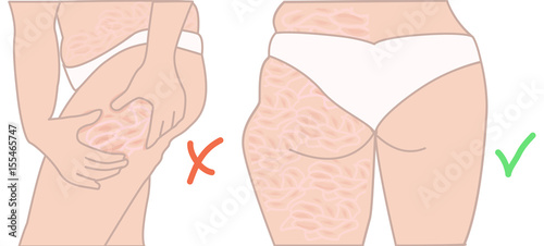 Cellulite before and after results. Transformation. Vector illustration