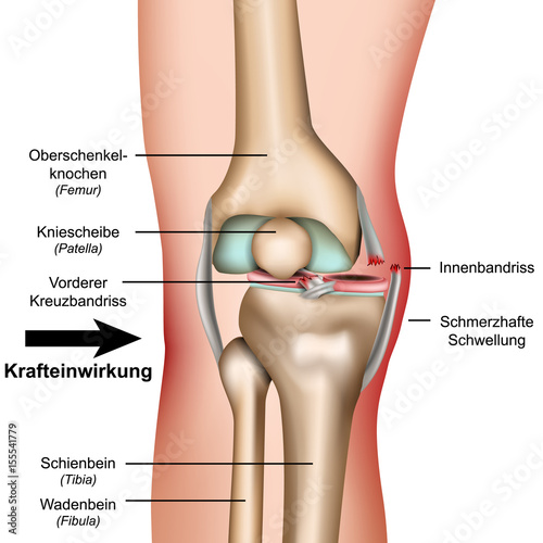Verrenkung des Knies durch grobe Gewalteinwirkungen