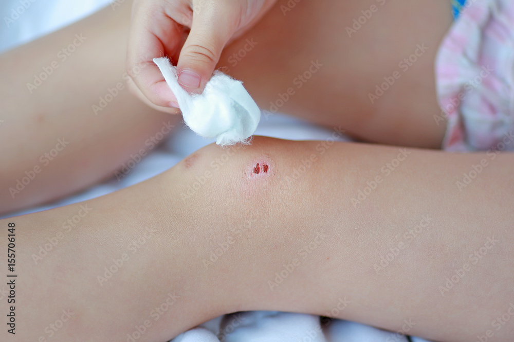 Close Up of child knee with a plaster (for wounds), Selective focus at bandage. Health care and medicine concept. Close Up of child knee with a plaster (for wounds), Selective focus at bandage. Health care and medicine concept.