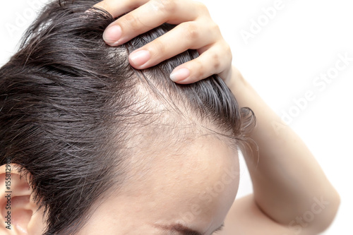 Bald man or woman worry about his or her less hairline on white background isolated