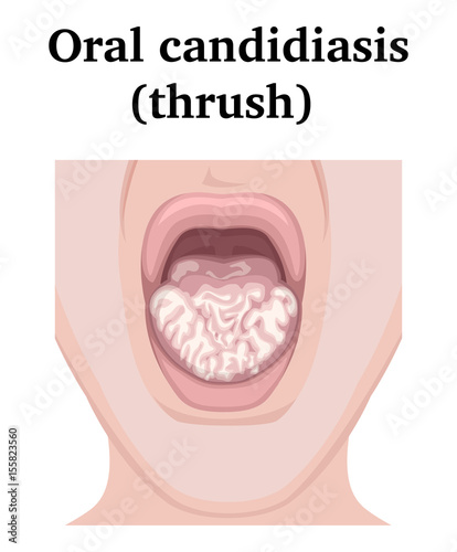 Illustration of Oral candidiasis