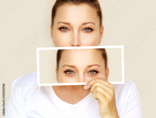 Obraz na plátně Lower Eyelid Blepharoplasty.