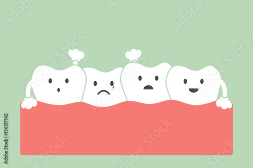 crowding teeth ( malocclusion ) photo