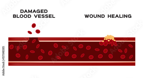 infographic of how blood vessel heal itself