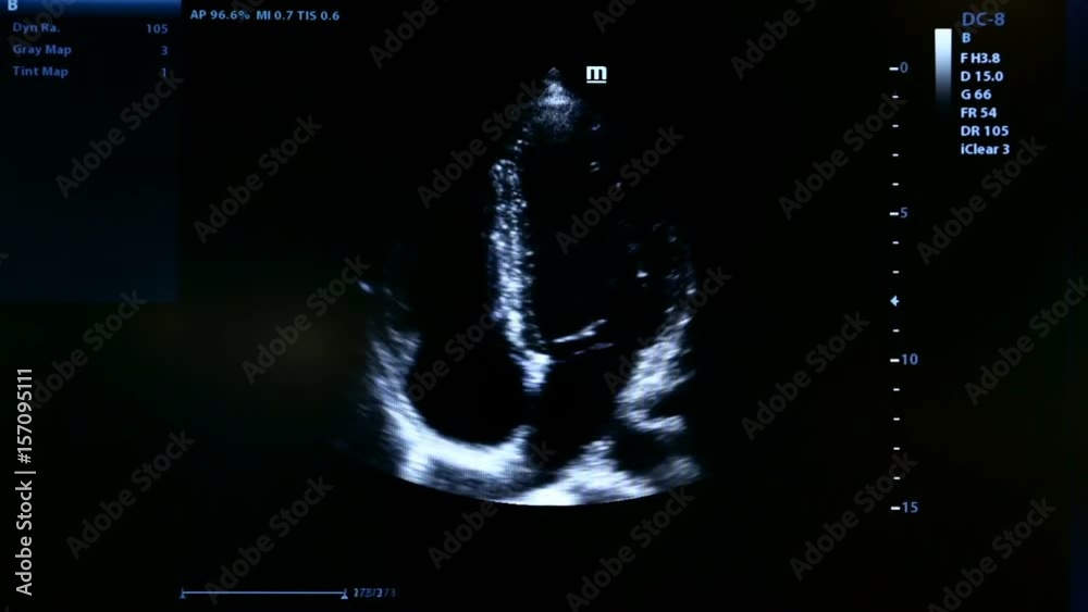 Colourful footage of homan heart ultrasound monitor