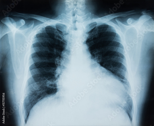 x-ray chest