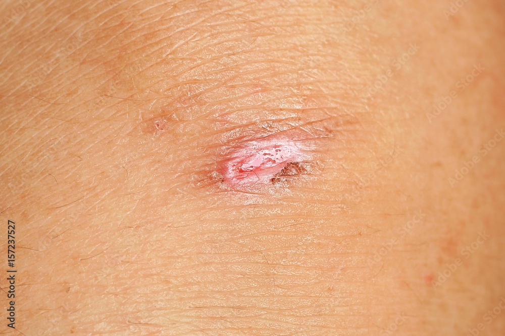 scar on the knee scar on the knee