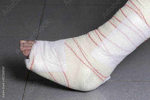 Foot soft splint for treatment of injuries from tendon inflammation.