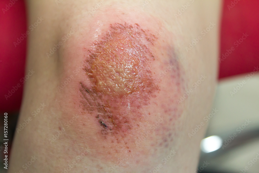 Fresh wound with lymph and blood on asian female knee background Fresh wound with lymph and blood on asian female knee background