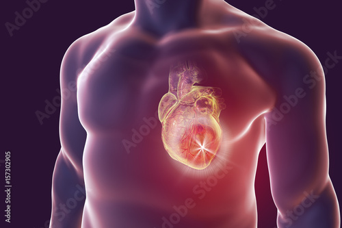 Canvas Print Heart attack, conceptual image for heart diseases