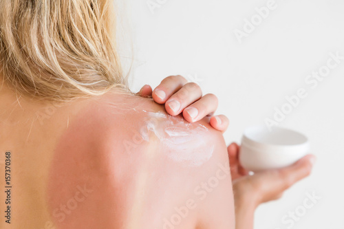 On woman's back skin smears cream after sun burn. photo