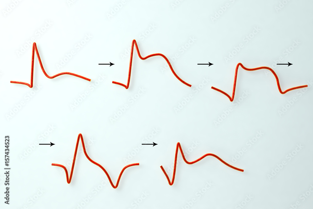 ECG in myocardial infarction. 3D illustration showing evolution of ECG with time ECG in myocardial infarction. 3D illustration showing evolution of ECG with time