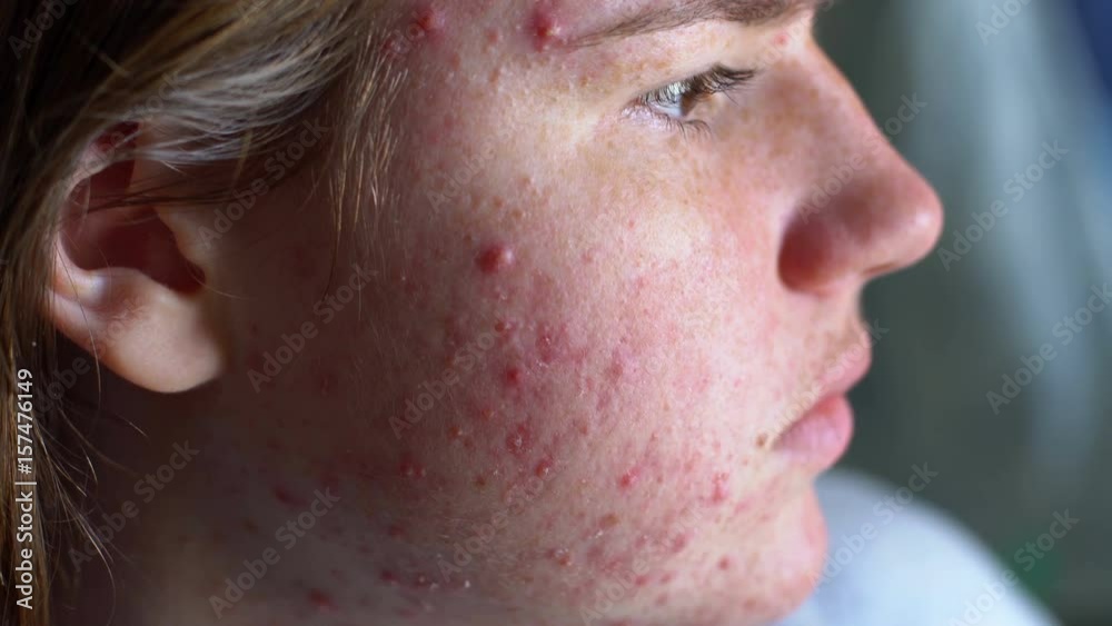 Depressed teenager with acne problem