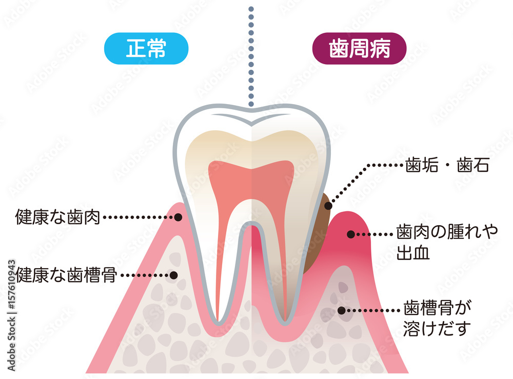 健康な歯と歯周病の歯 比較 Stock イラスト Adobe Stock