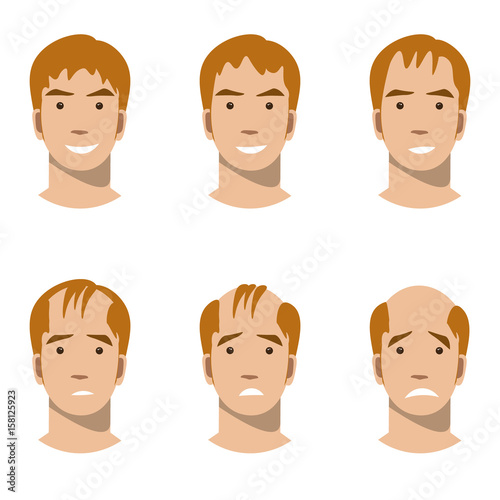 Stages of hair loss and hair treatment