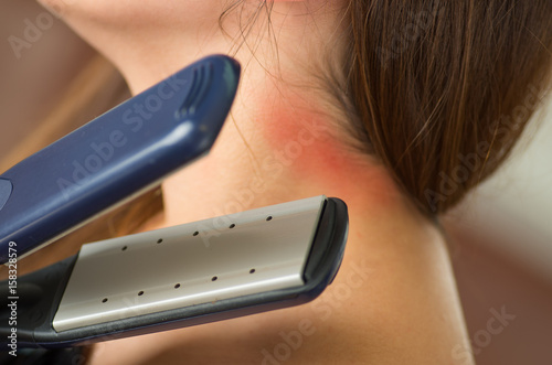 Close up of a woman burned her shoulder using her ironing hair