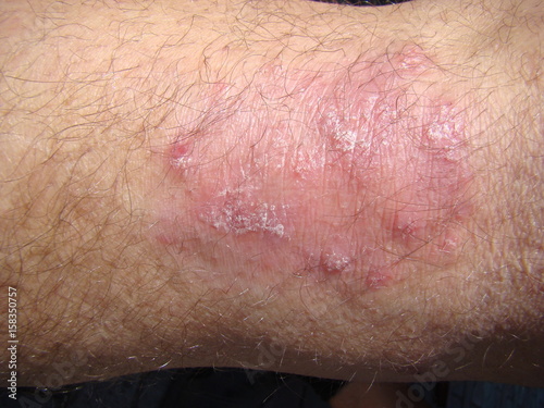 psoriasis