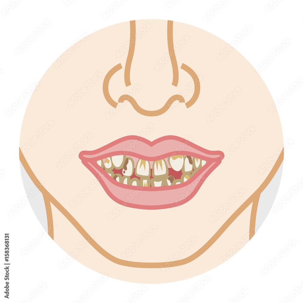 Naklejka premium Bad dentition and dirty teeth