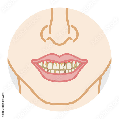 Tooth decay and Dirty Teeth