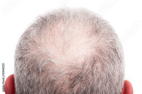 Man scalp with hair loss problem