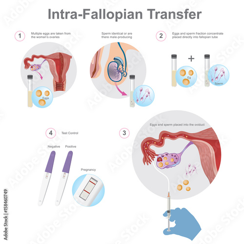 Intra-Fallopian Transfer