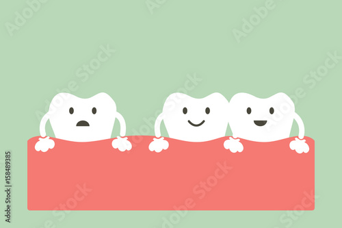 spacing teeth ( diastema )